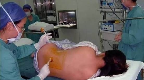 性生活|剖腹产的伤口,对女性身体会不会产生伤害,妇产科医生说出真相