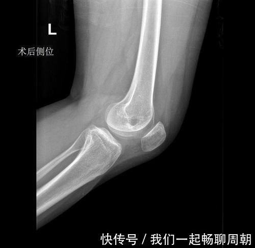x光片|左边膝盖疼了1年多,结果查出来这一系列问题