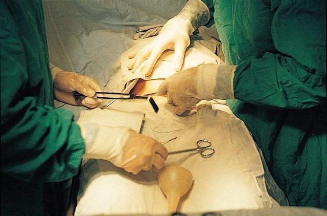 剖腹产|第一次剖腹和第二次有什么不同医生说出实话，孕妈要心里有数