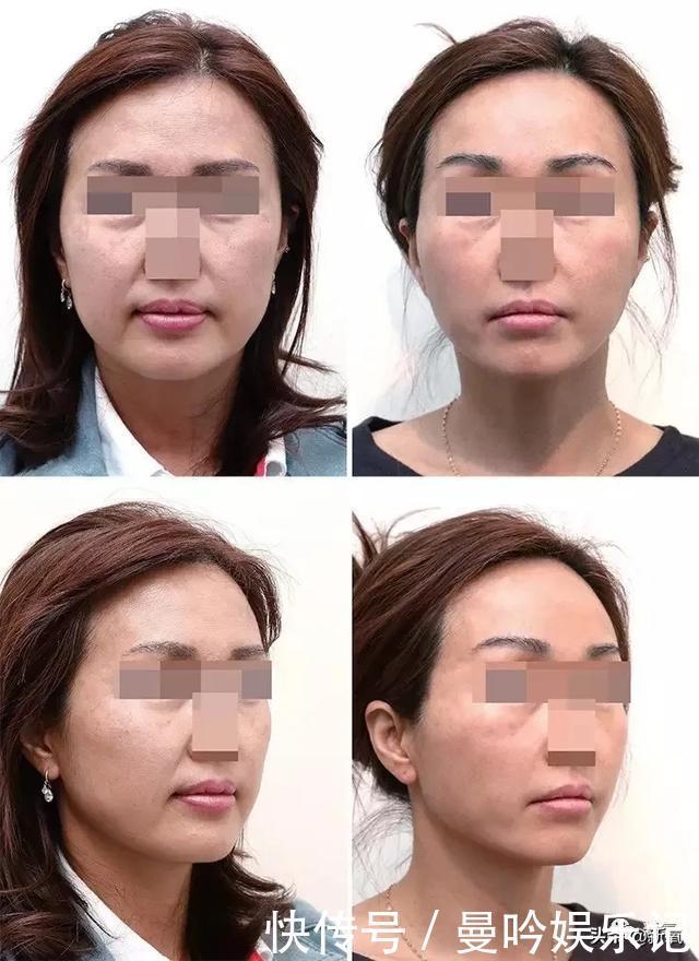 半个娱乐圈女明星脸上都有的这个坑,真的是线雕的锅吗?