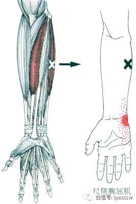 激痛点疗法 尺侧腕屈肌 快资讯