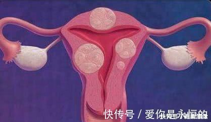 保健品|女性如何预防子宫肌瘤?不用担心喝豆浆,真正要远离3种常见美食