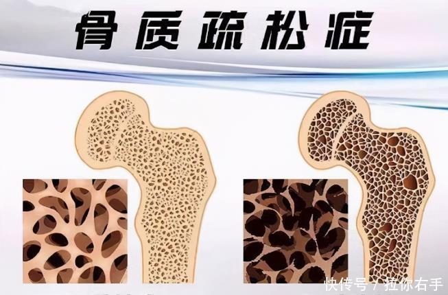 医生提醒骨质疏松不害怕,做到3点,骨骼健康又