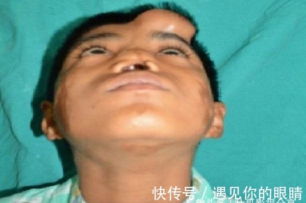 额头|国外小男孩鼻子长在额头上,看了他的经历,真是坚强的表率