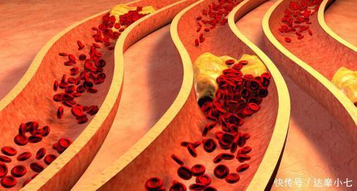 血液|首次公开:97岁院士,从血脂黏稠到血液清澈,只因常做2件事