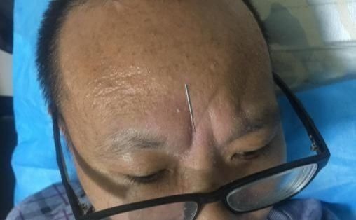 委中|脑出血瘫痪生活不能自理，中医只用1招就让他走起来了