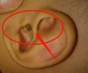 孩子|4岁男孩出去郊游后,他总是说耳朵疼,医生点了灯,父母害怕退后