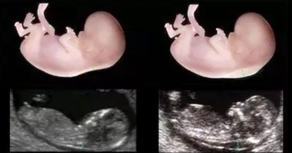 孕妈|孕妈不想生下“傻孩子”,孕期几项产检要按时做,忽视不得