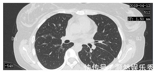 癌细胞|23岁女孩癌细胞全身扩散，一年抗癌出奇迹