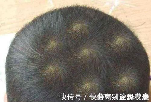 孩子|孩子头顶“旋”越多暗示智商越高吗?专家:要根据实际情况判断