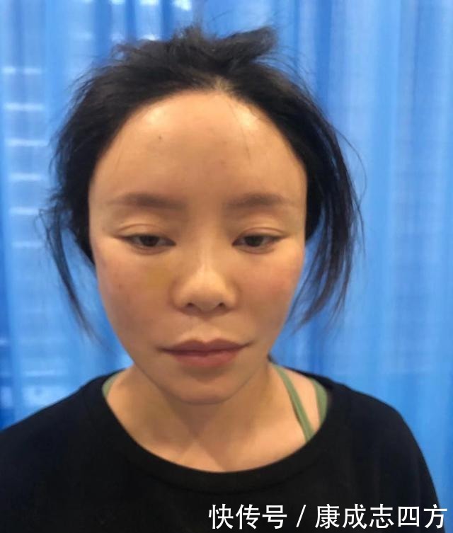 求美者|小拉皮术后1个月,总结几点我的体验感受