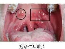 肠道病毒|警惕！这种病进入高发，会传染！