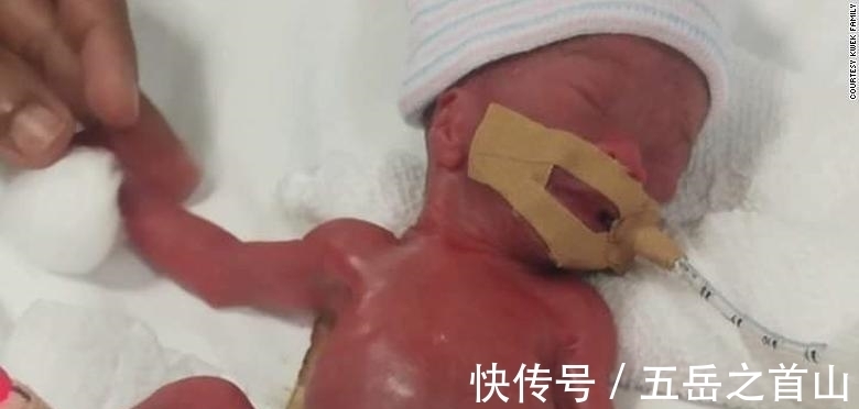 奇迹|生命的奇迹?出生仅212克的“世界最小婴儿”顺利出院