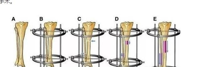 断骨|当年因矮身高自卑，花16万断骨增高7.2厘米的李亚诺，后来如何？