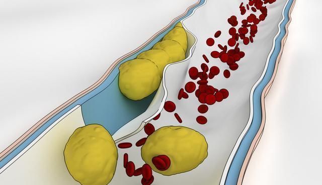 不适感|体内有栓,睡觉先知,若睡觉时有这三个现象,说明血栓或已形成
