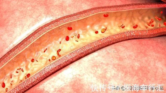 中成药|既能抗凝又能降脂稳定斑块？聊一聊常用的中成药——通心络胶囊