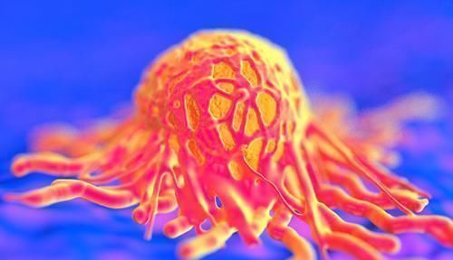 肿瘤|2种癌症一旦患上，会飞速发展到晚期越拖越糟糕