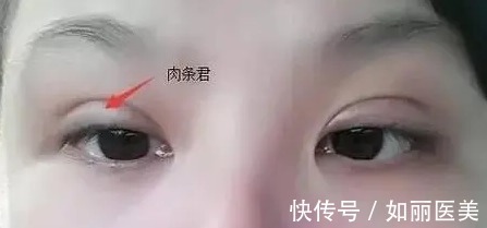 肉条 做双眼皮手术很有可能会产生肉条？你还是会割双眼皮吗