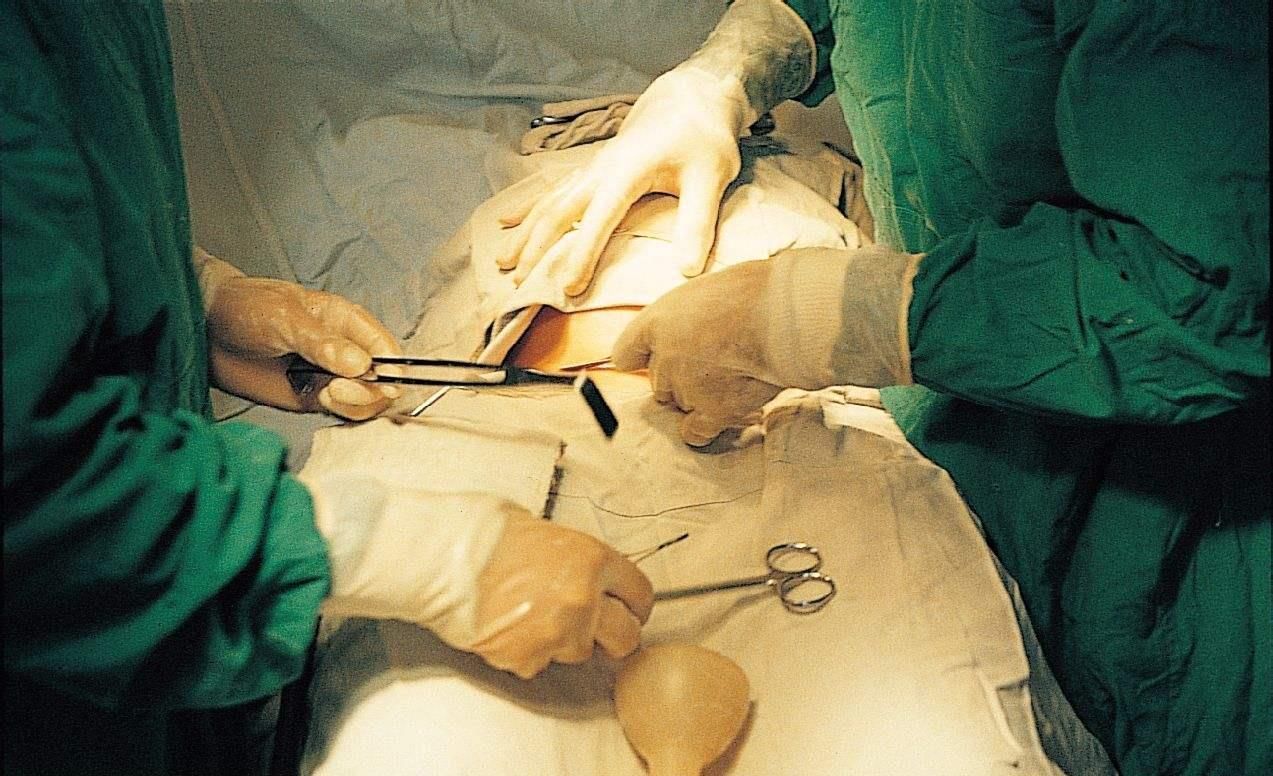 分娩|头胎顺、二胎剖，宝妈用亲身经历告诉你，顺产与剖腹产之间的区别