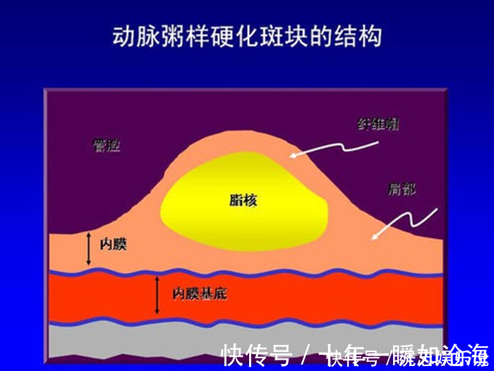 导管|血管支架能穿进人的血管,为何不直接用支架把血管里的血栓吸出