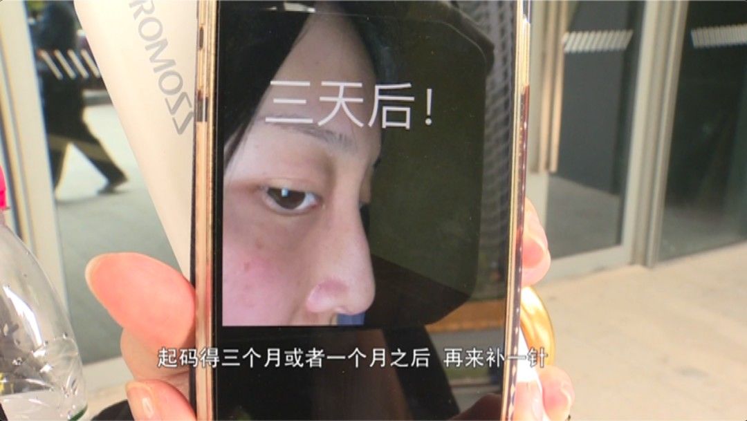 3天就变回原样！女子花高价注射玻尿酸中的“爱马仕”，结果却入了个“无底洞”