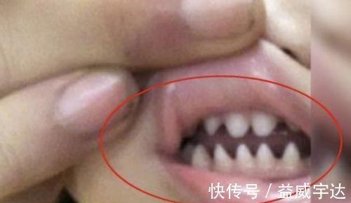 医生|2岁宝宝长出“鲨鱼牙”,妈妈慌忙带娃就医,医生:夜奶惹的祸