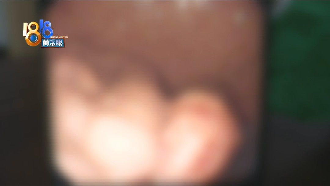 泡椒猪皮|12岁孩子胃部长“肿瘤”，可能跟吃了两年辣条泡面有关