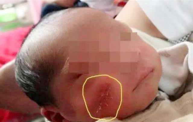 吃奶|5年前因吃奶太用力,被妈妈刮成“花脸猫”的宝宝,如今怎么样了