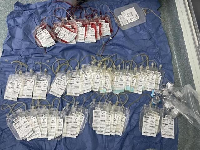 血管|罕见！“子宫肌瘤”9斤重，竟顺着血管长进心脏！14个学科联手成功摘瘤