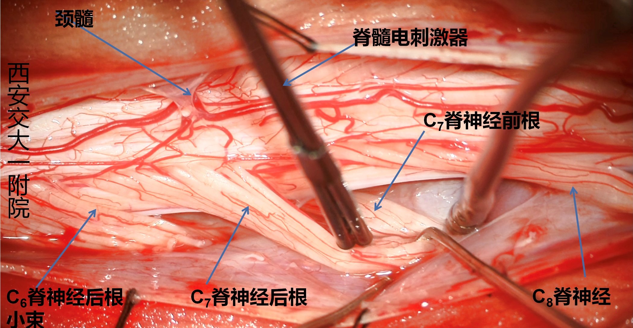 神经外科|西部首例！西安交大一附院神经外科完成颈段选择性脊神经后根部分切断术治疗偏瘫