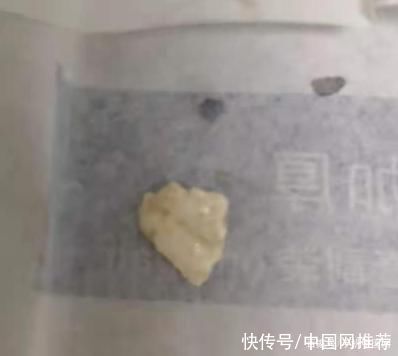 胰岛素抵抗|皮肤长出石头?六旬老伯长期吃海鲜手脚严重变形