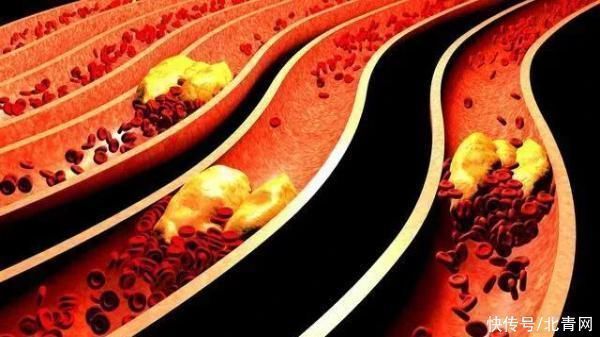 沙棘油|甘油三酯高的人群，少吃两物，坚持两事