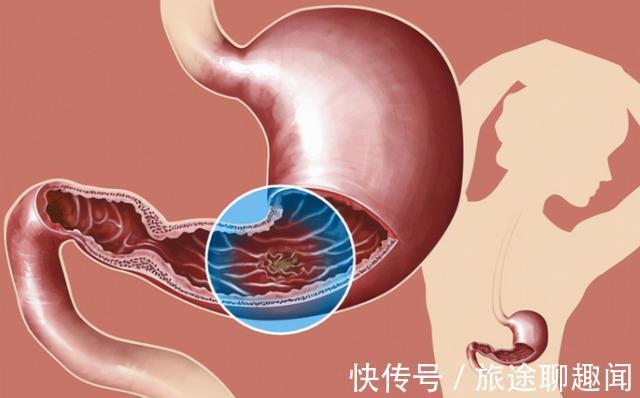 蔬菜|医生建议:想养胃的人,尽量避免吃这几种蔬菜,胃或会为你点赞