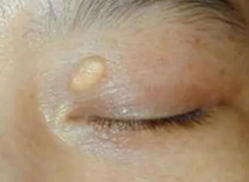 高血脂|血脂升高是因米饭吃多了？提示：3种蔬菜少吃点，或有助稳定血脂