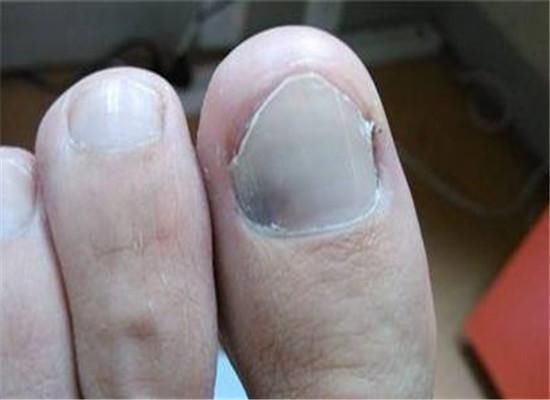 亮红灯|糖尿病“来临”时,“脚上”会有3处亮红灯,若一个都没有恭喜!