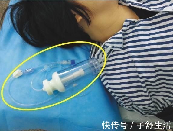 疼痛感|剖腹产后该不该使用镇痛泵?医生讲出其中利害,全由家属来做决定