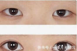 开眼角手术 开眼角手术怎么做才能不留疤隆鼻能改善眼角吗!