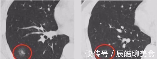 肺结节|可以让肺结节消除或者不长大吗?为什么一定要随访?