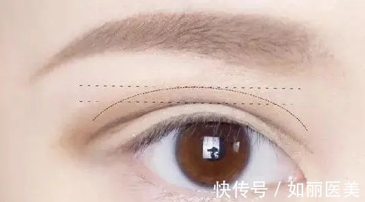 眼部 全切双眼皮多久能恢复正常?术后效果怎么样?快来看看吧