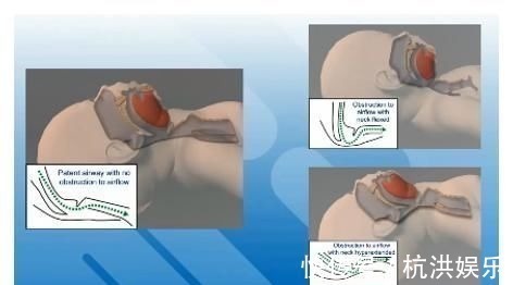 正压|宝宝出生后全身青紫,急救只用4分钟!这个方法得学!