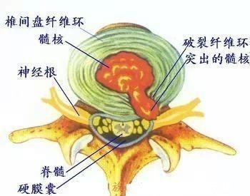 神经根|颈椎病严重时，什么部位会疼得厉害！