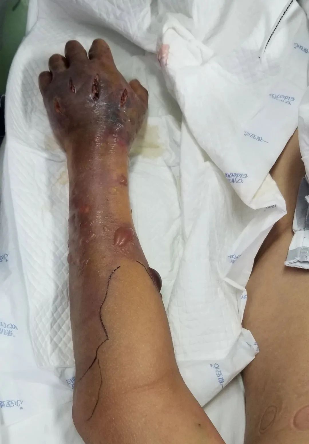 感染性休克|老人洗了一条鱼,竟然进了ICU!医生:“立即截肢,否则性命不保!”