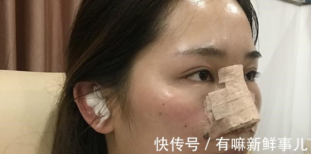 手术 隆鼻术后假体穿透鼻尖,这也太吓人了!