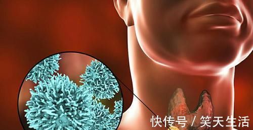 甲状腺查出了小结节,是不是肿瘤呢?该不该手术切除呢?