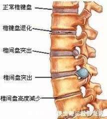 腰椎间盘突出的各种疗法！看这一篇就够了！