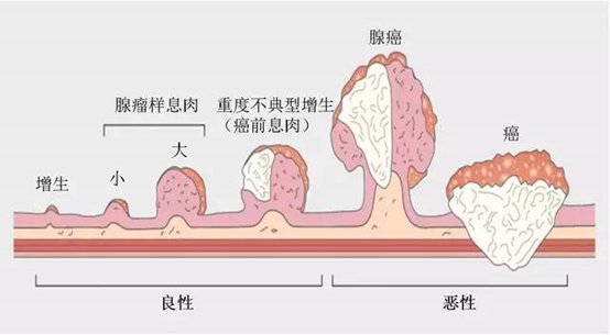 结肠癌|一反“肠”态，小心这个癌症悄悄找上门