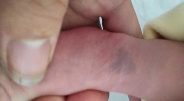 新生|宝妈以为新生宝宝身上的是朱砂痣,被网友着急评论:赶紧送医院