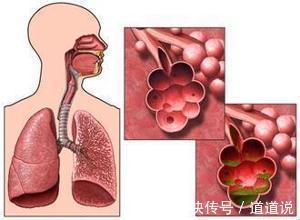 阻塞性|肺气肿病发的原因是什么?