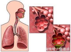 阻塞性|肺气肿病发的原因是什么？