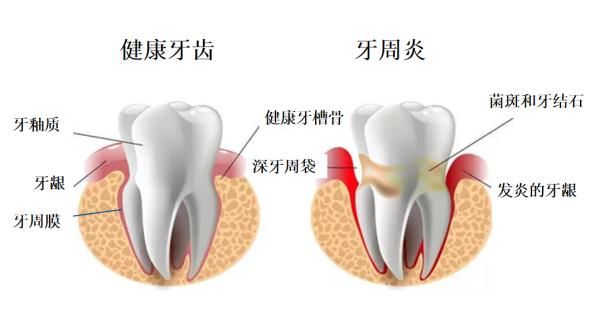 牙菌斑|刷牙出血？因为口腔太脏！来听牙菌斑的悄悄话~